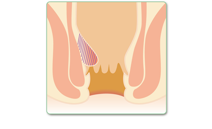 Ⅱ度　排便時にいぼが外に出るが、自然と中へ戻る。