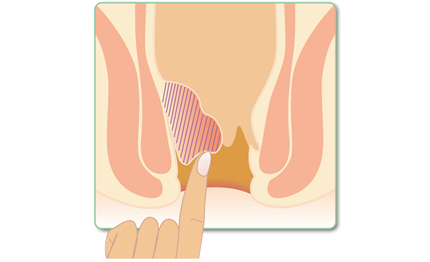 Ⅲ度　排便時にいぼが外に出て、指で戻さないと中へ戻らない。
