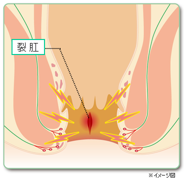 裂肛（きれ痔）とは