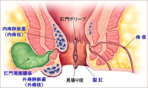 痔イメージ